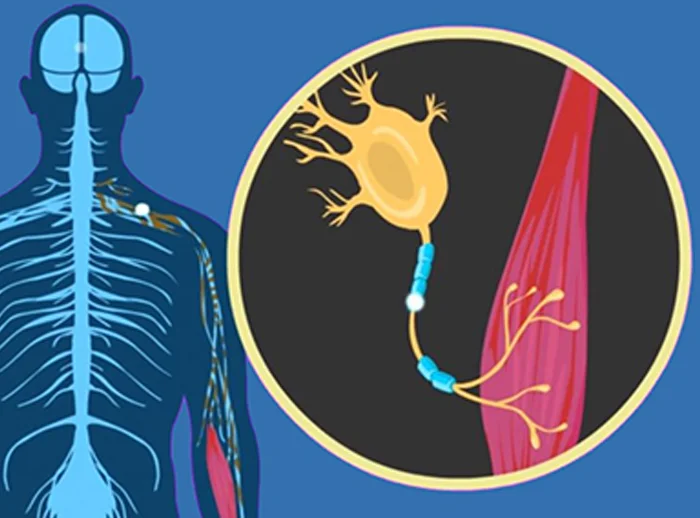 Amyotrophic Lateral Sclerosis (ALS) Treatment in Delhi